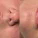 professional lip filler treatment